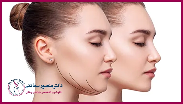 نکات مهم مراقبتی بعد از لیپوماتیک غبغب