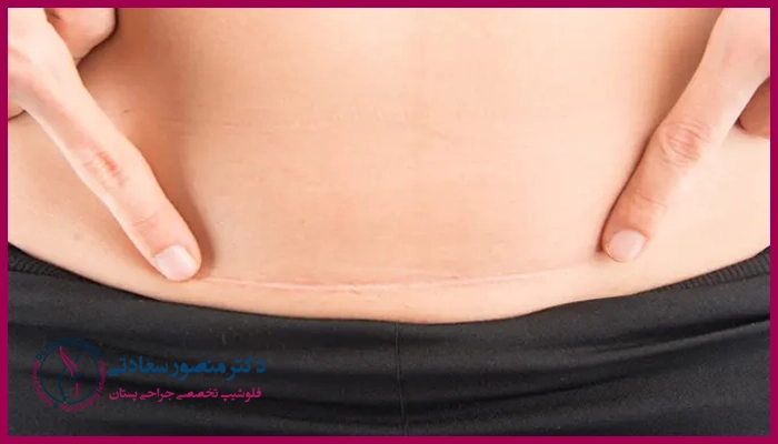 مراحل انجام جراحی مینی ابدومینوپلاستی