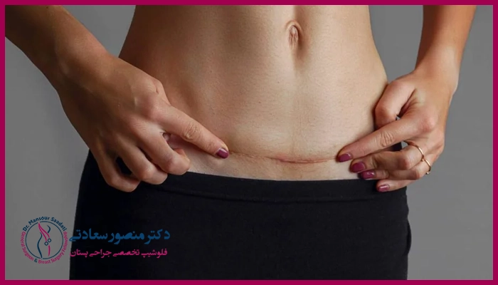 مزایای جراحی مینی ابدومینوپلاستی