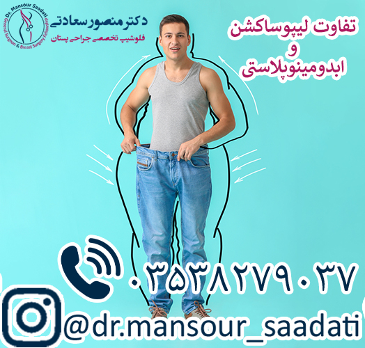 تفاوت لیپوساکشن و ابدومینوپلاستی
