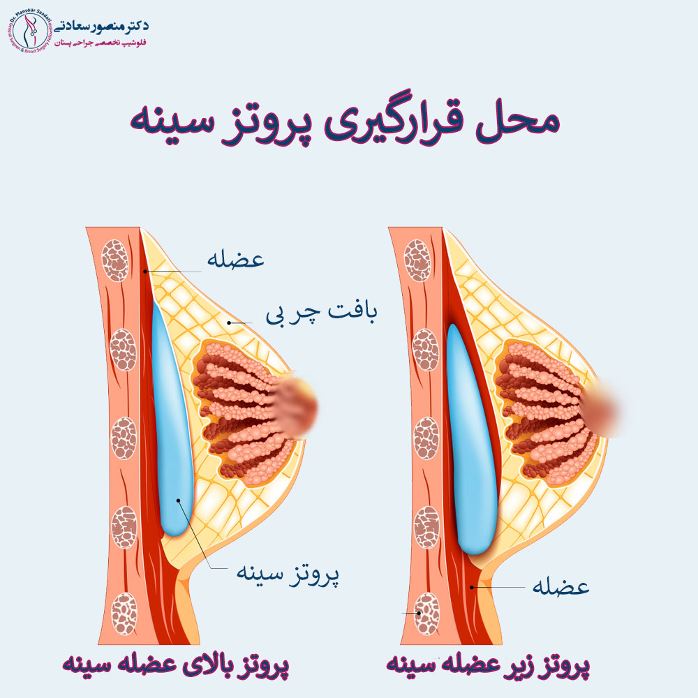 پروتز-سینه-زیر-عضله