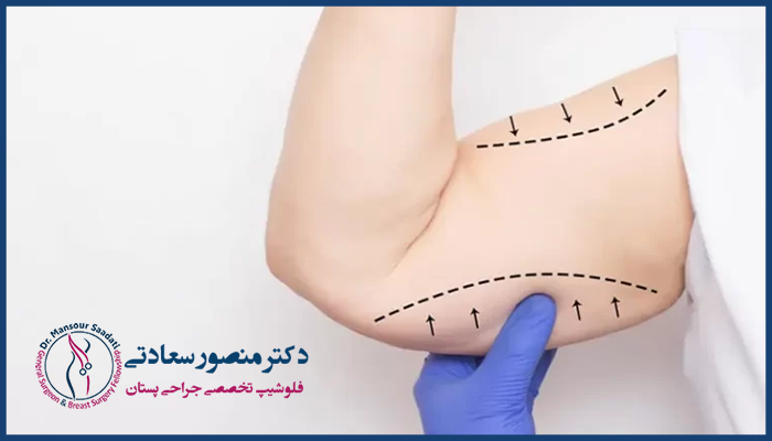 لیپوماتیک بازو در یزد