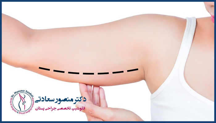 مهم ترین نکات مراقبتی بعد از لیپوماتیک بازو