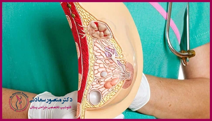 نکات مراقبتی که بعد از جراحی نوک سینه باید رعایت کرد!