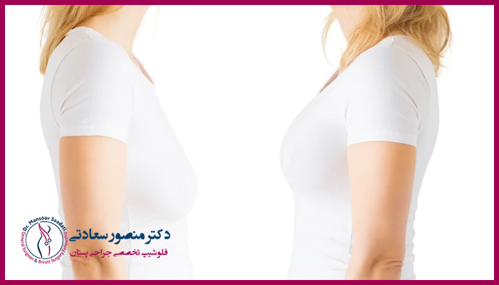 اهمیت رعایت مراقبت های بعد از لیفت سینه