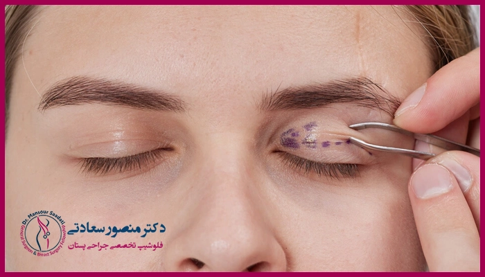 جراحی بلفاروپلاستی چه عوارضی دارد؟