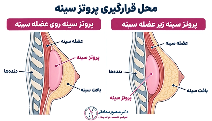 محل قرارگیری ایمپلنت سینه